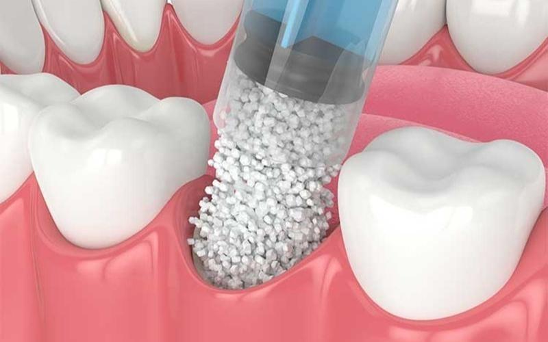 Ghép xương răng nếu được nha sĩ yêu cầu, để tránh bị nhỏ mặt sau khi nhổ răng khôn