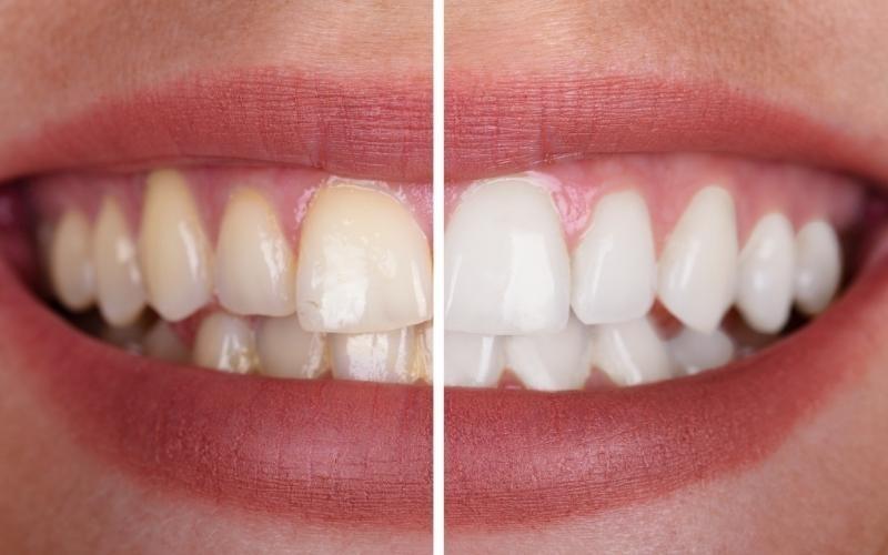 Hiệu quả tẩy trắng răng sẽ phụ thuộc vào mức độ răng bị nhiễm màu