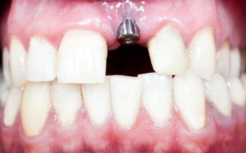 Trụ răng Biotem không gây ảnh hưởng đến mô mềm