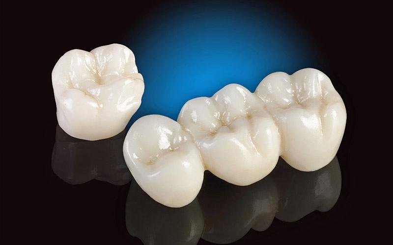Răng tạm được khuyên nên dùng khi bọc răng sứ