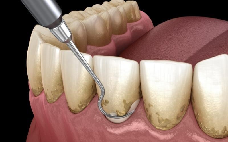 Tình trạng cao răng tích tụ nhiều có thể gây chảy máu khi lấy cao răng