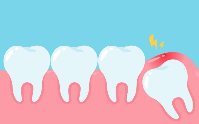 Lợi sưng đỏ là dấu hiệu thường gặp và dễ nhận biết khi bị viêm lợi trùm răng khôn