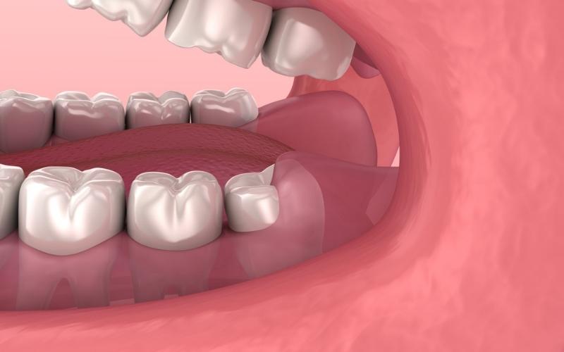 Lợi trùm lên răng khôn có mủ là một biến chứng nặng cần được chữa trị kịp thời