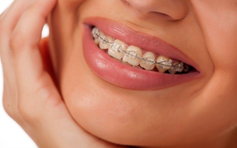 Niềng răng có thể cải thiện tình trạng lệch mặt