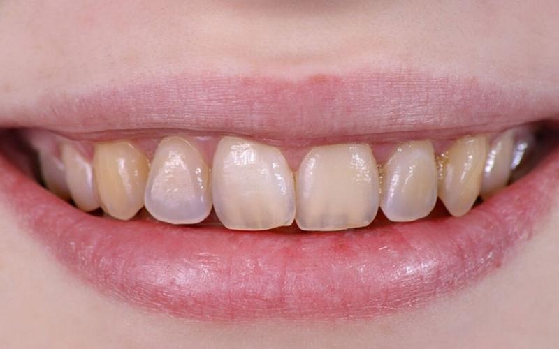 Men răng bị mòn dễ gây ê buốt khi lấy cao răng