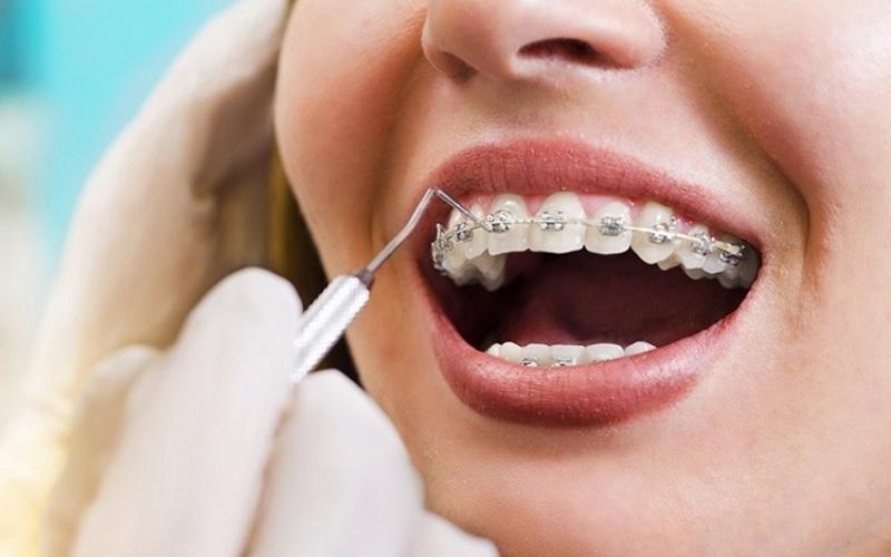 Bác sĩ khuyến cáo nên niềng răng trước