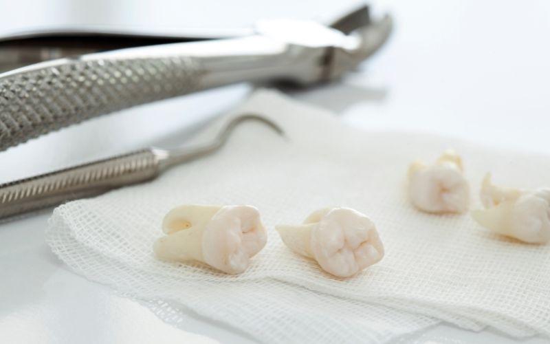Nha sĩ sẽ chỉ định bạn nhổ 4 răng khôn cùng lúc nếu bạn đáp ứng được các tiêu chí về sức khỏe