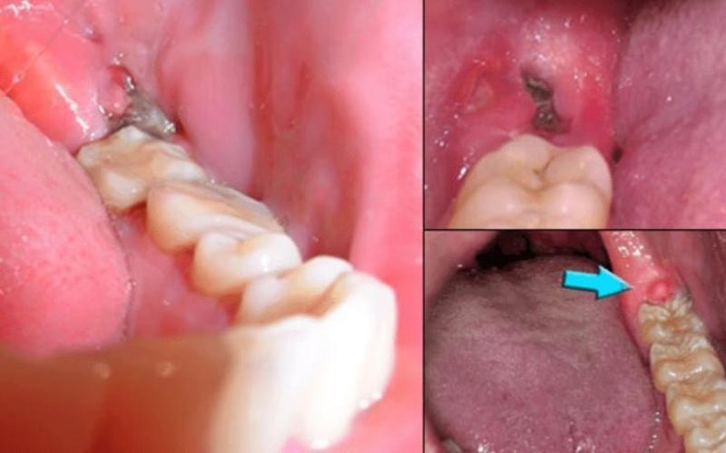 Nhiễm trùng trong quá trình nhổ răng khôn