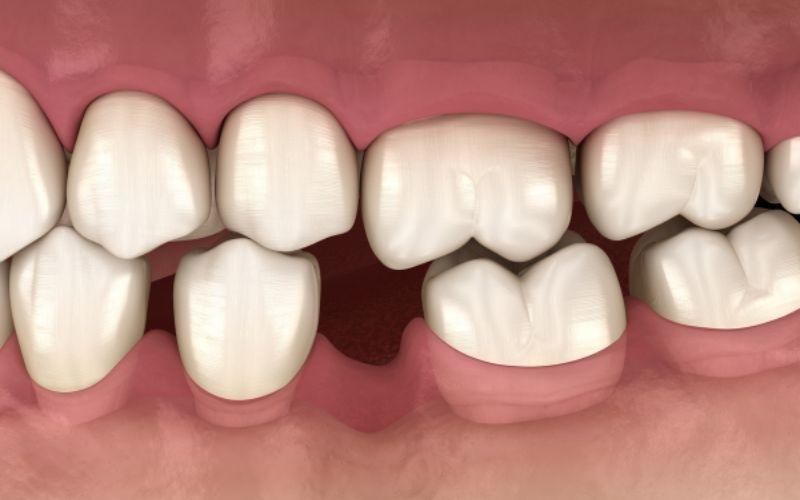 Nướu răng bị tụt do tiêu xương