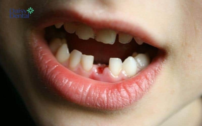 Răng sữa rụng dần nhường chỗ cho răng vĩnh viễn