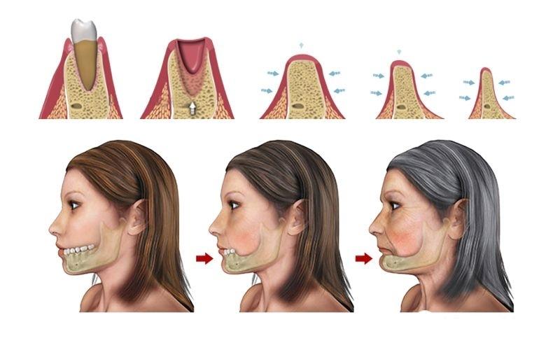 Quá trình tiêu xương hàm khi bị mất răng