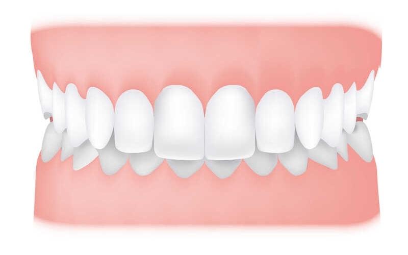 Răng hàm số 6, 7 là các răng không thay được