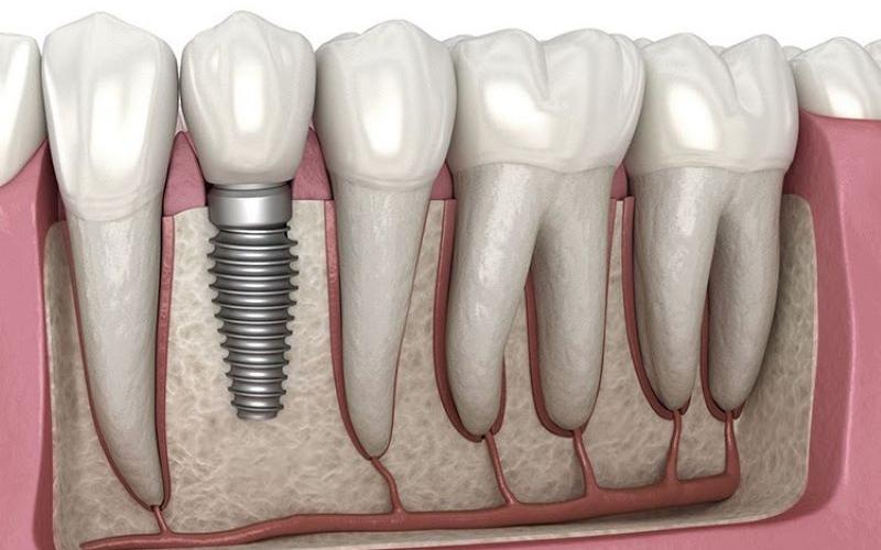 Răng trồng Implant dễ bị giắt thức ăn