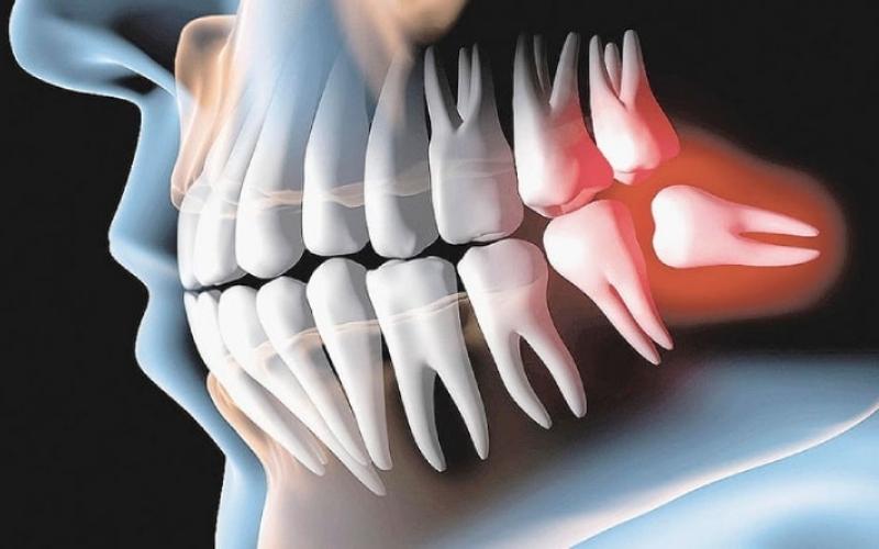 Răng khôn mọc thường gây ra nhiều cơn đau nhức, khó chịu kéo dài