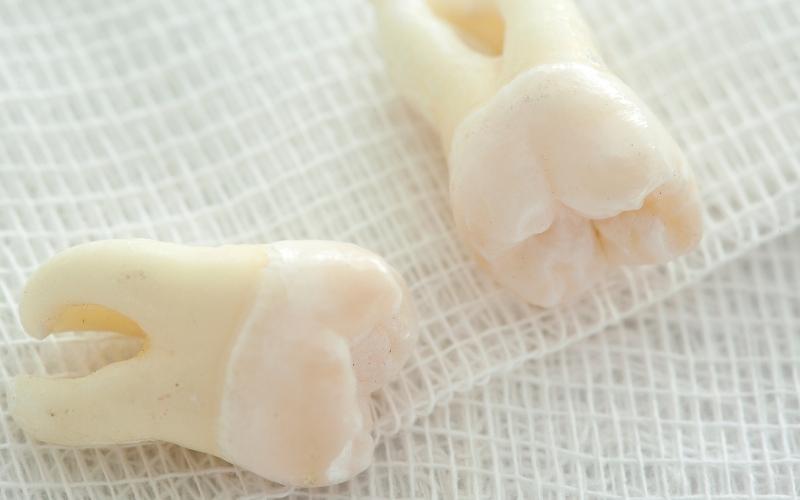 Răng khôn nhổ rồi sẽ không mọc lại nữa