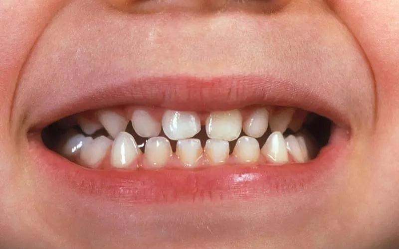 Răng sữa không rụng có thể là dấu hiệu của nang răng