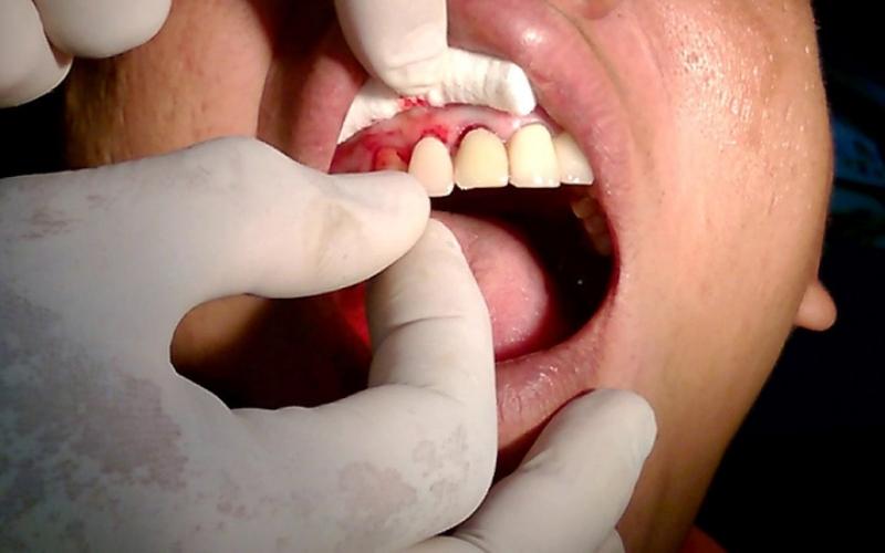 Khi răng tạm bị rớt, bạn nên đến phòng khám để bác sĩ gắn lại