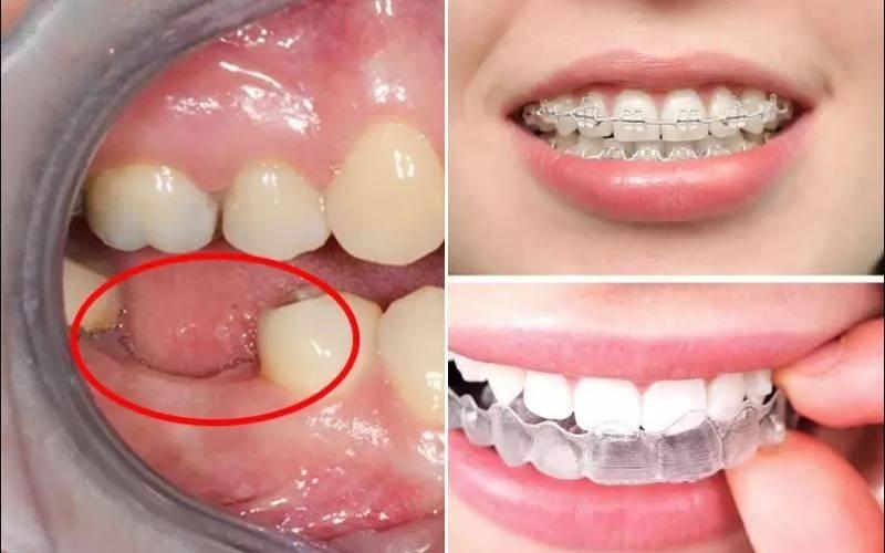 Tiêu xương hàm có niềng răng được không tùy thuộc vào tình trạng răng miệng