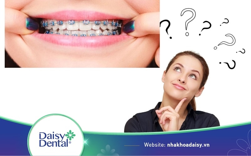 giai đoạn xấu nhất khi niềng răng
