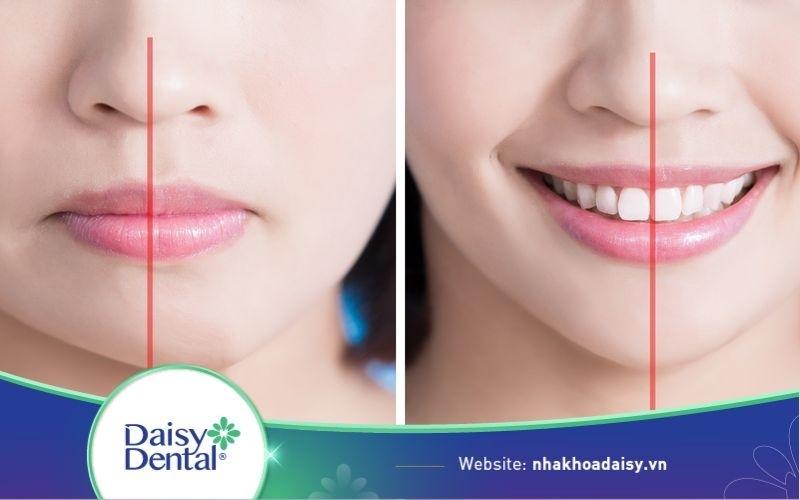 mặt lệch bên cao bên thấp