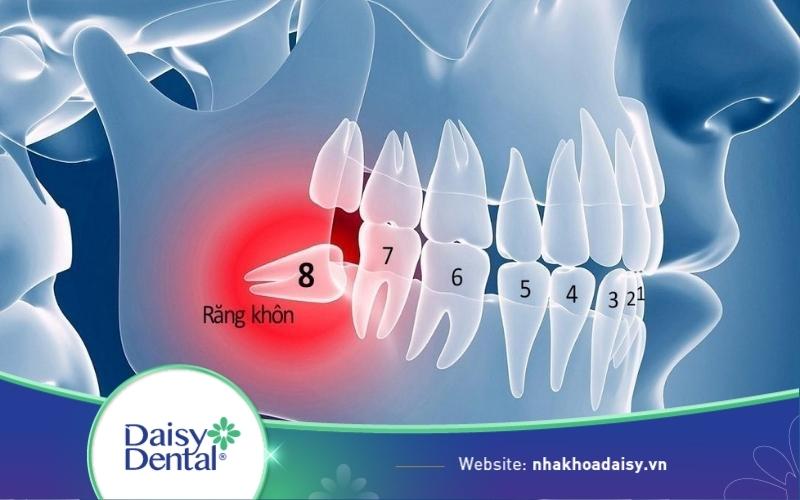 Răng khôn mọc lệch 45 độ