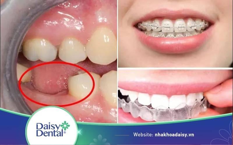 Tiêu xương hàm có niềng răng được không