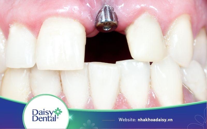 Trồng Implant răng cửa giá bao nhiêu tiền? Mất bao lâu?