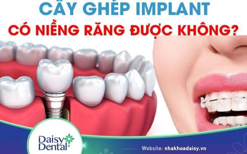 Trồng răng Implant có niềng răng được không