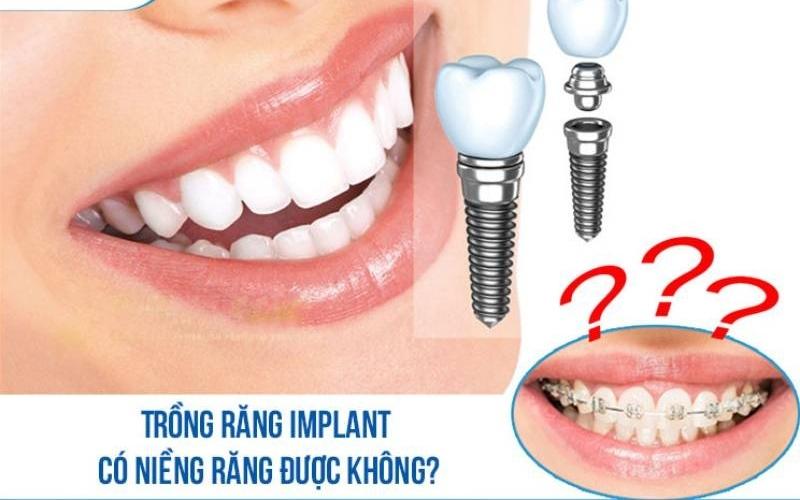 Trồng răng Implant có niềng răng được không?