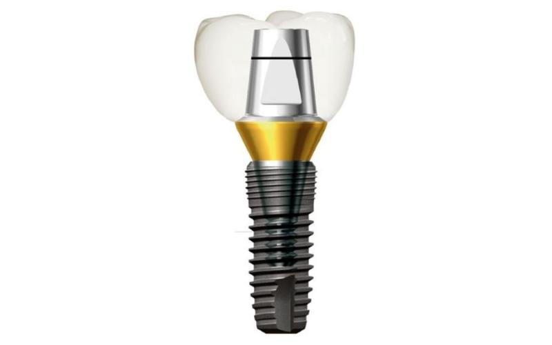 Implant Dentium Hàn Quốc có nhiều ưu điểm