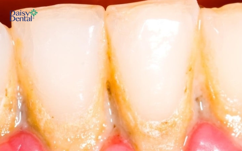 Vôi răng là các mảng bám cứng dính trên răng có màu vàng, nâu