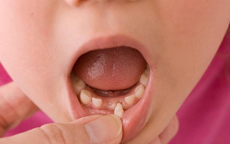 Tình trạng răng bị chấn thương khi bé té ngã