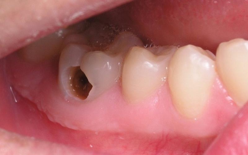 Sâu răng do bọc răng sứ bị lệch khớp cắn