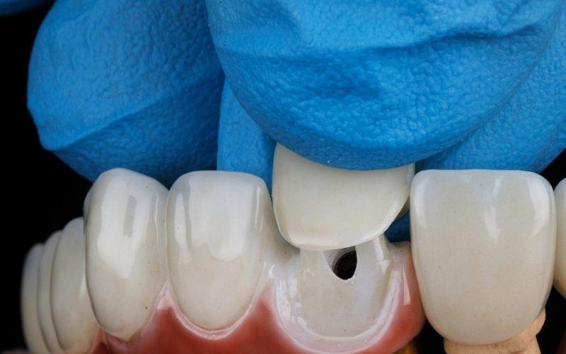 Bọc răng sứ bảo vệ răng hiệu quả khỏi tác nhân gây hại