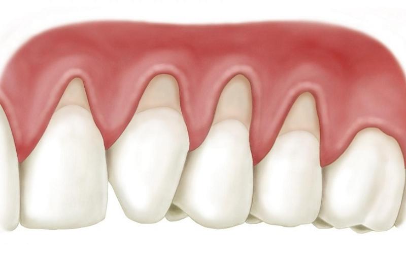 Cao răng huyết thanh có thể gây ra tụt lợi
