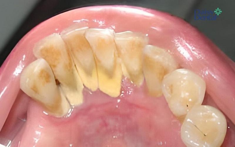 Cao răng là những mảng bám cứng xuất hiện chủ yếu ở cổ chân răng