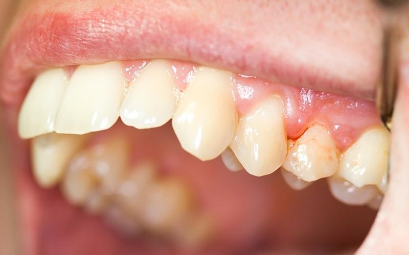 Khi phần chân răng có cảm giác đau nhức và chảy mủ thì nên lấy tủy răng
