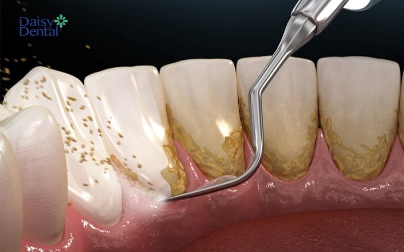 Chữa tụt lợi ở giai đoạn nhẹ bằng cách lấy cao răng