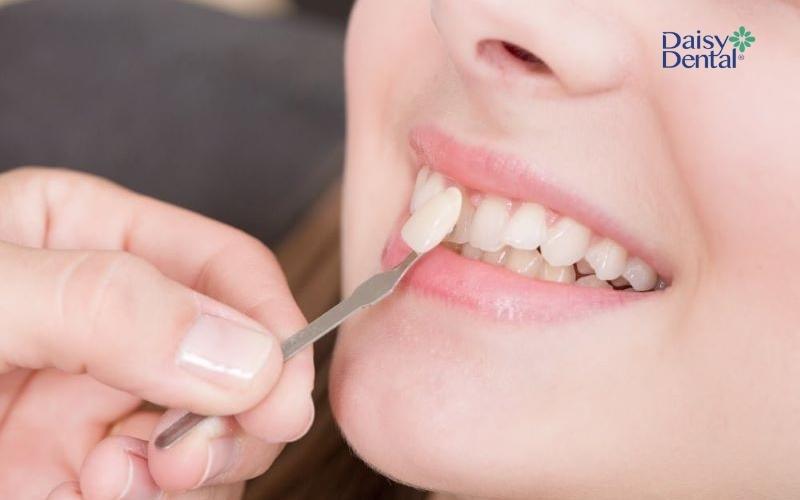 Dán răng sứ kiểu răng thỏ thực chất là dán sứ Veneer dựa trên form răng của bạn