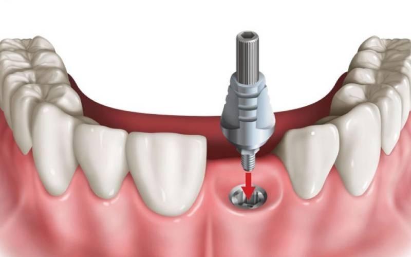 Hình ảnh trụ răng Implant