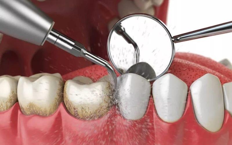 Lấy cao răng khắc phục tình trạng tụt lợi nhẹ