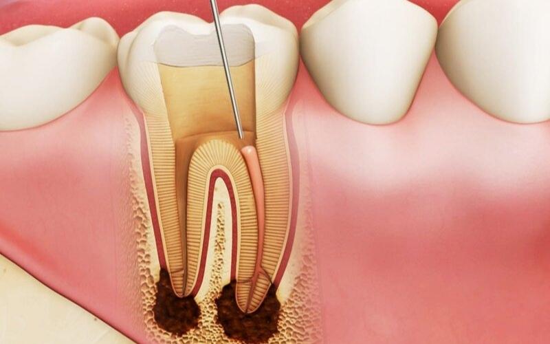 Lấy tủy răng là việc làm cần thiết khi răng bị sâu nặng