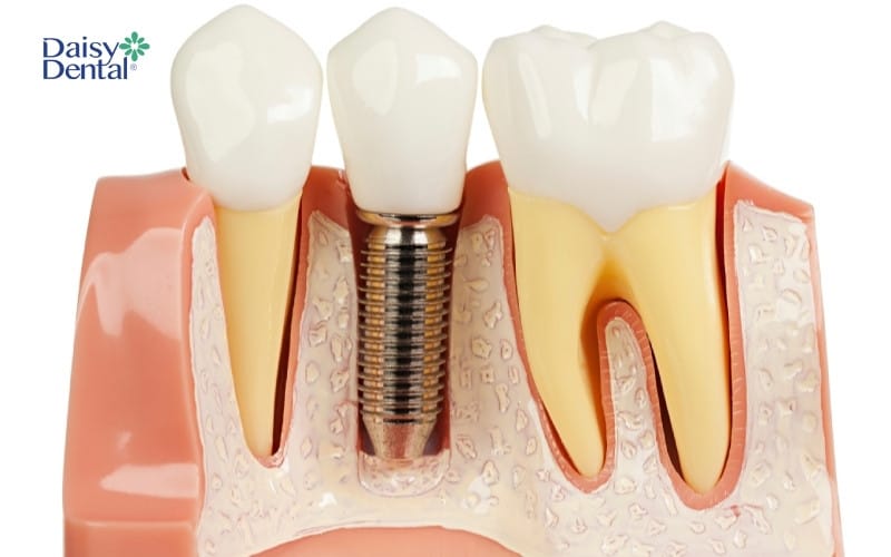 Mô hình răng Implant