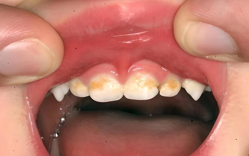 Ngà răng bị lộ là dấu hiệu của tình trạng răng sữa của bé bị mủn