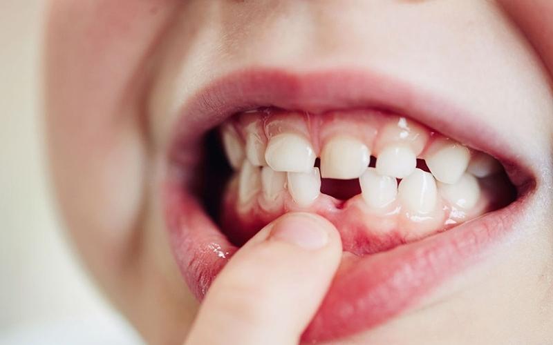 Việc nhổ răng sữa bằng chỉ có thể gây ám ảnh cho trẻ
