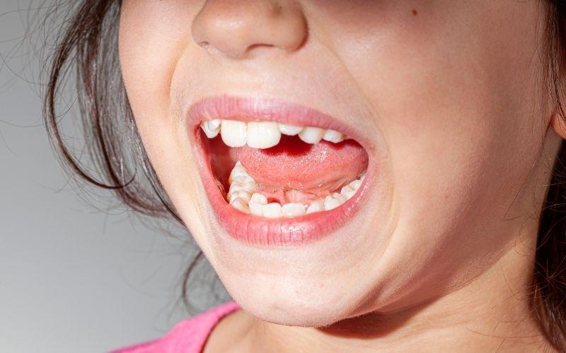 Nhổ sót chân răng sữa sẽ khiến răng vĩnh viễn mọc lệch lạc