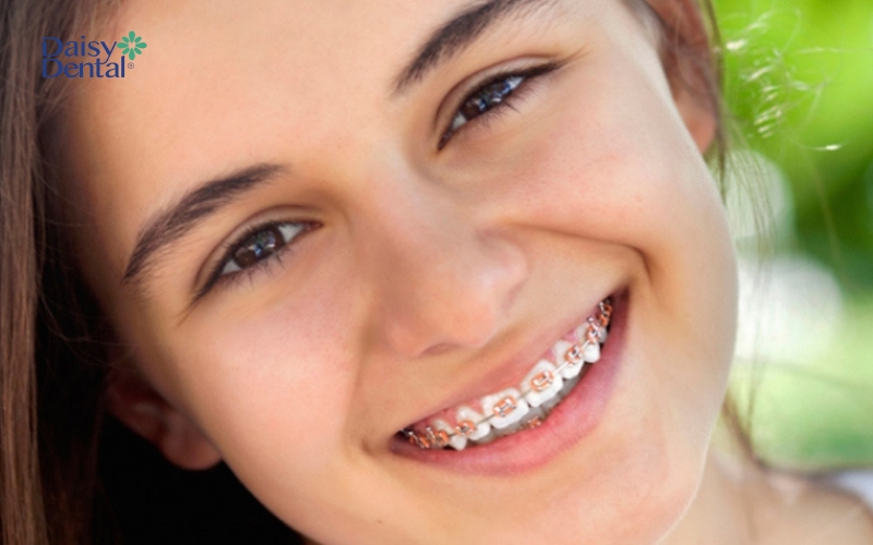 Niềng răng cho trẻ 16 tuổi có chi phí thấp hơn người lớn