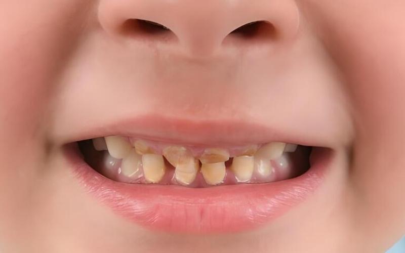 Răng sữa của bé bị mủn có thể gây ra nhiều bệnh lý răng miệng khác