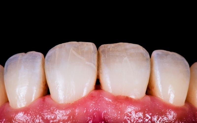 Răng sứt mẻ gây viêm tủy