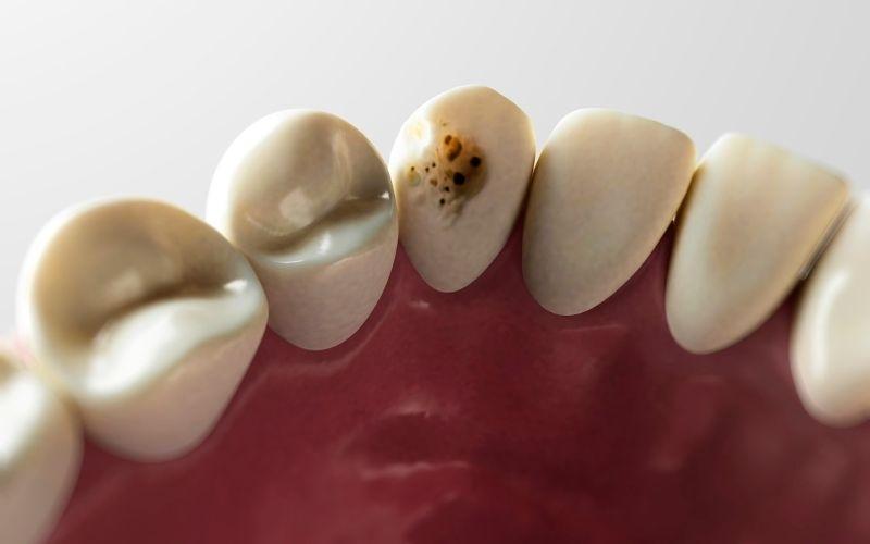 Răng bị sâu dễ làm viêm tủy